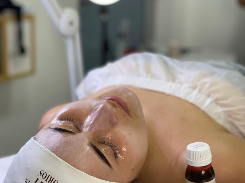 Chemical peels treatment at Regener8 Aesthetics, Birmingham